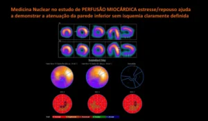 Cintilografia Miocárdio atenuação