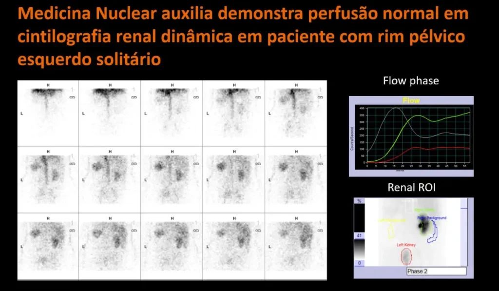 Cintilografia Renal Dinamico