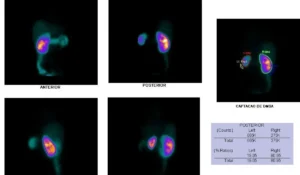 Cintilografia Renal Estatica