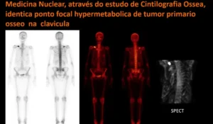 Cintilografia óssea